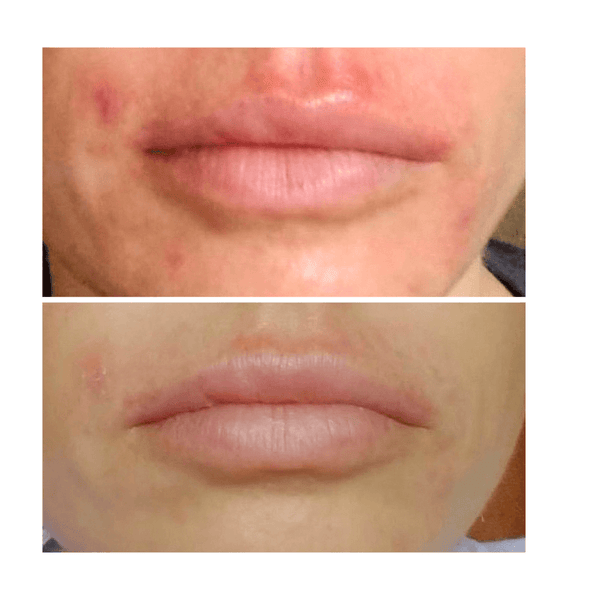 2 treatments with Total Clearing, 1 week