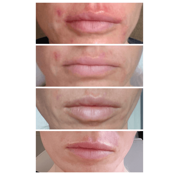 2 treatments with Total Clearing, 1 week