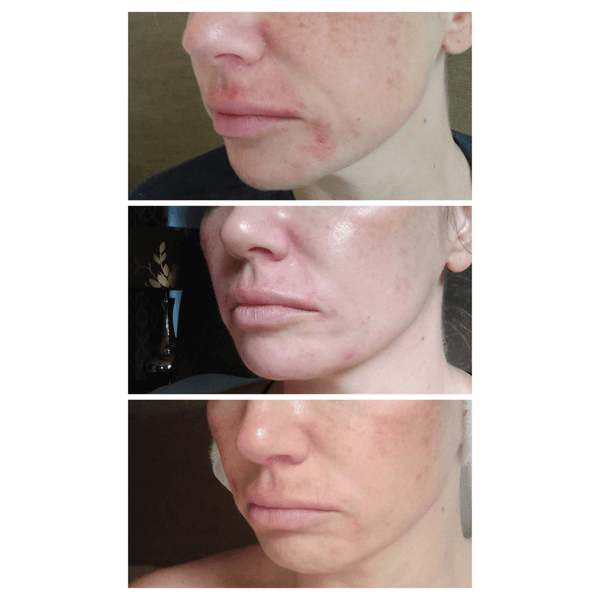 2 treatments with Total Clearing, 1 week