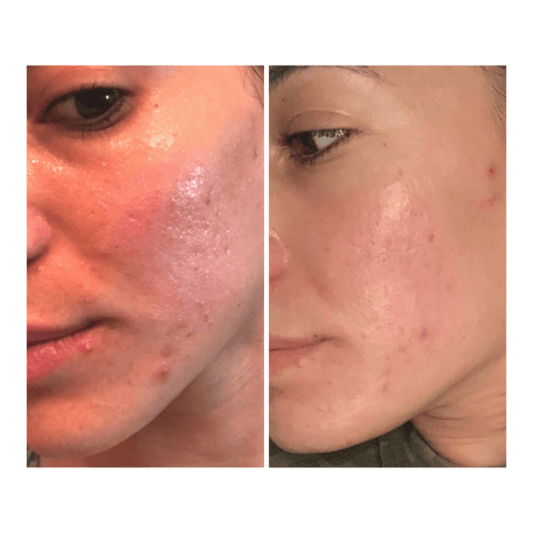 Total Clearing & Pigment, 3x weekly (alternating days) over 11 days